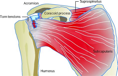 Supraspinatus Tear 